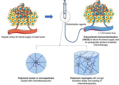 Recent Advances on Polymeric Beads or Hydrogels as Embolization Agents for Improved Transcatheter Arterial Chemoembolization (TACE)